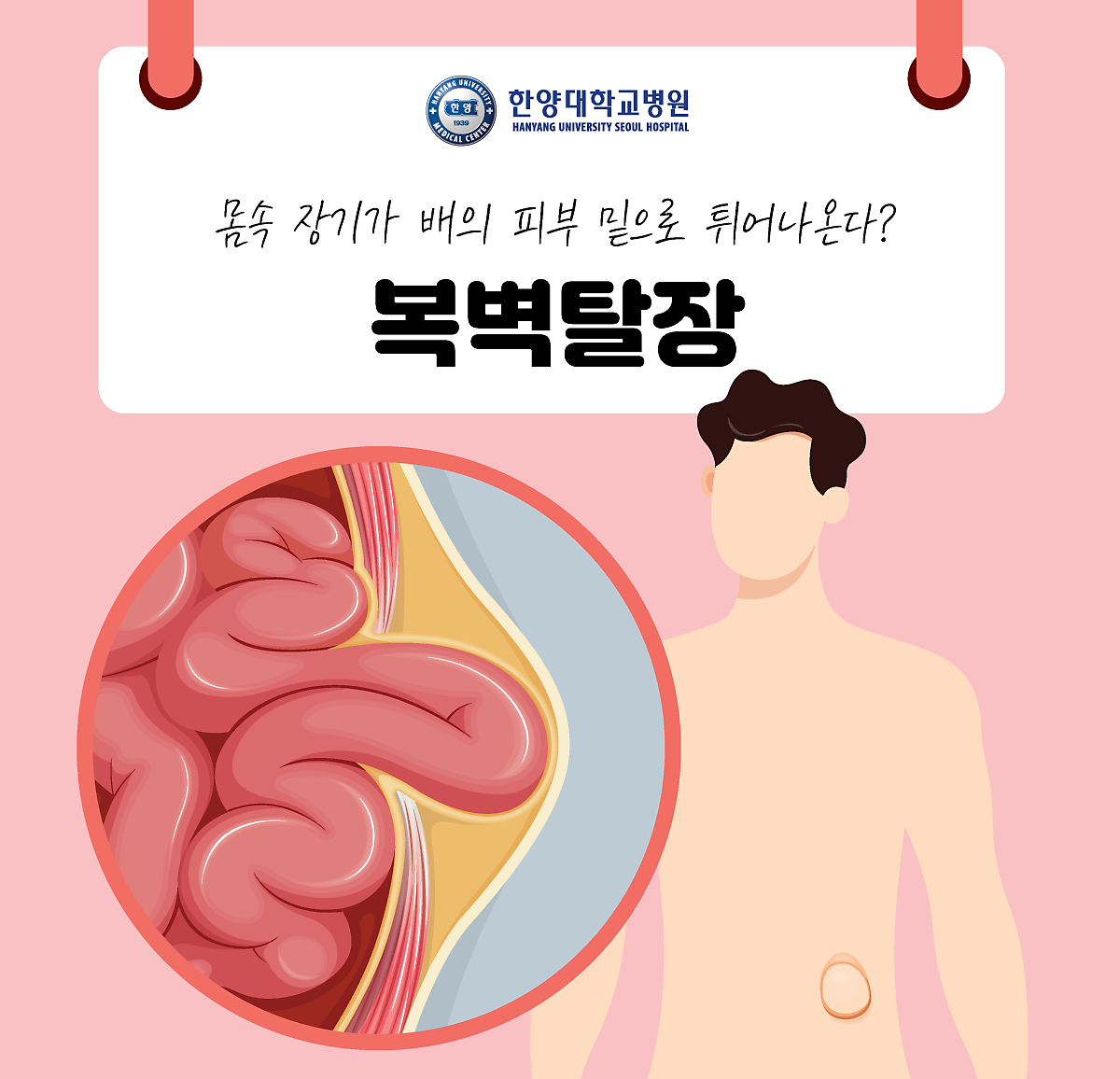 몸속 장기가 배의 피부 밑으로 튀어나온다? 복벽탈장